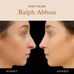 rhinoplastie ultrasonique