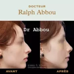 Rhinoplastie Paris