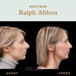 resultat rhinoplastie