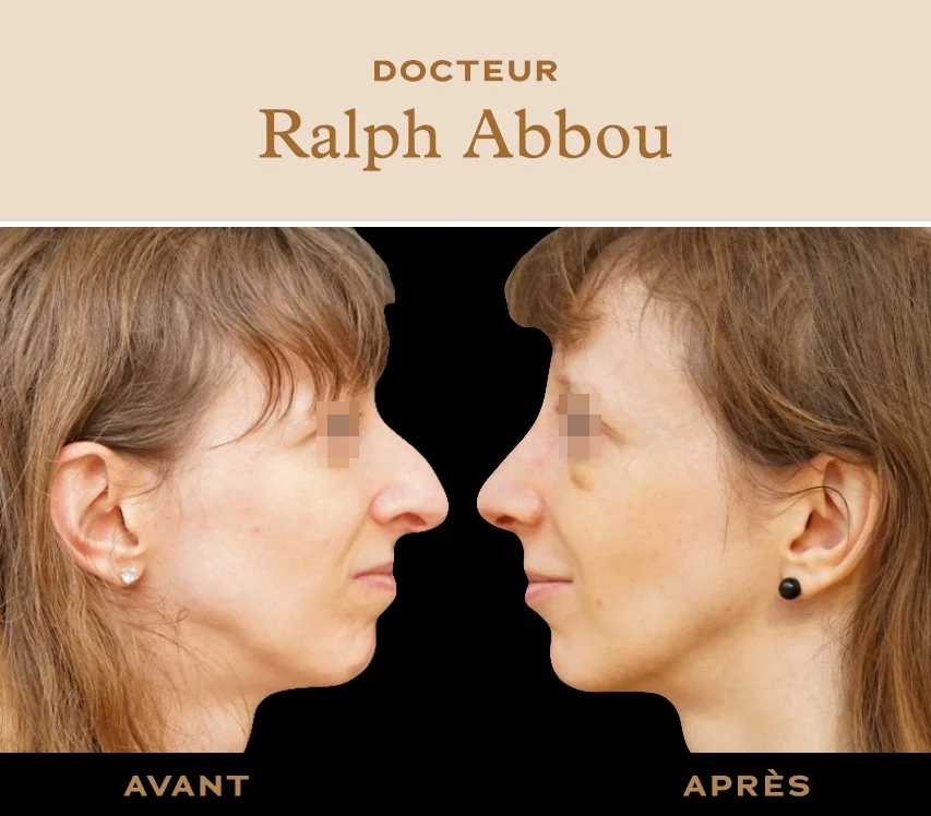 Bosse sur le nez à Paris. Rhinoplastie Dr Ralph ABBOU