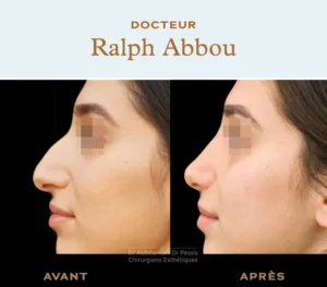 Ultrasonic rhinoplasty
