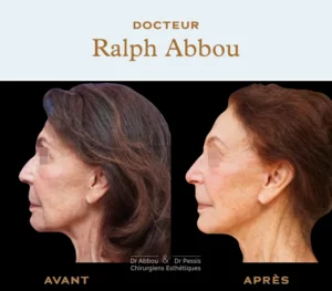 Facelift Paris