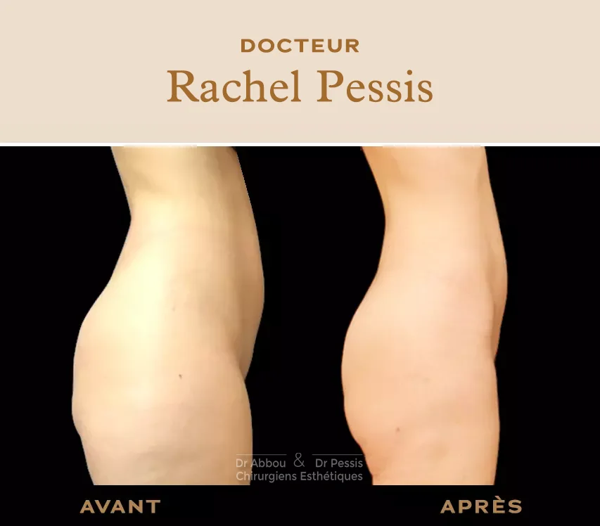 Lipoaspiration (liposuccion ventre) à Paris - Dr Rachel Pessis