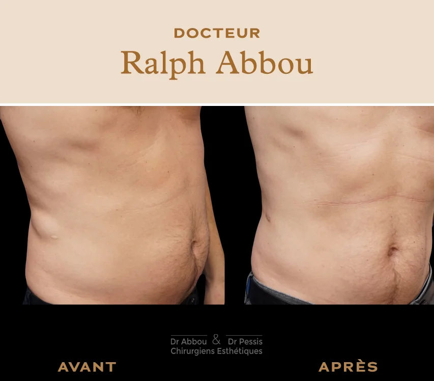 Chirurgie des lipomes Paris - Dr Abbou et Dr Pessis