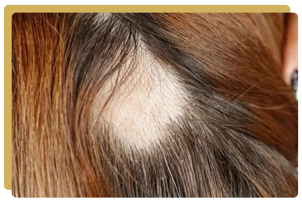 Loupe cuir chevelu