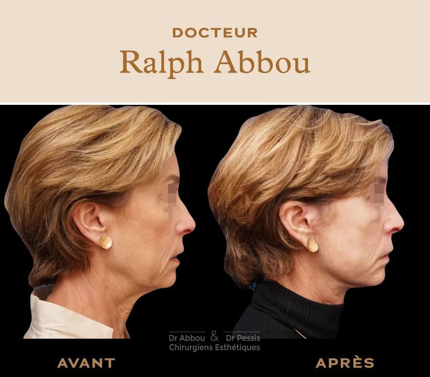 Mini Lifting du visage à Paris