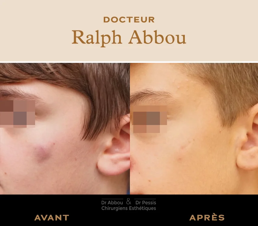 Chirurgie des kystes Paris - Dr Abbou et Dr Pessis