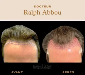 implants capillaires à paris