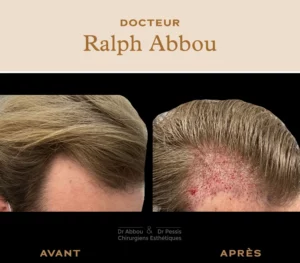 Greffe de cheveux paris