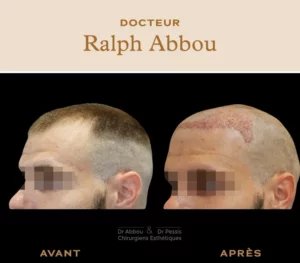 Greffe de cheveux paris