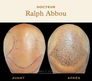 Greffe-cheveux-vertex paris