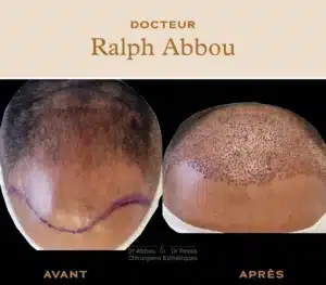 greffe-de-cheveux
