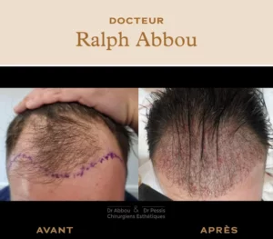 Greffe de cheveux à paris