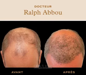 Greffe cheveux paris