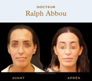 Forehead reduction Paris