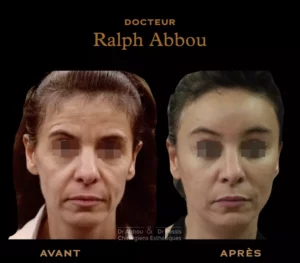 endoscopic facelift paris