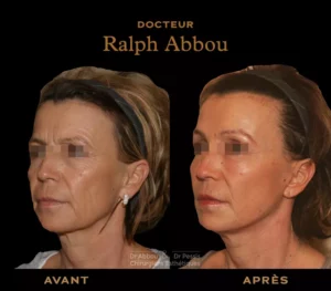 endoscopic facelift paris