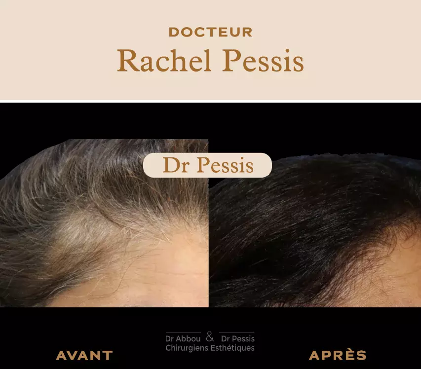 Mesotherapie cheveux Paris. Dr ABBOU et Dr PESSIS