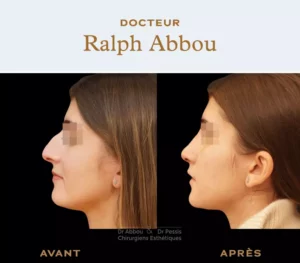 Ultrasonic rhinoplasty Paris