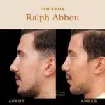 rhinoplastie ultrasonique