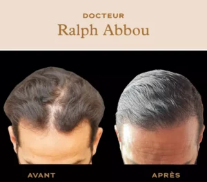 greffe-de-cheveux-paris