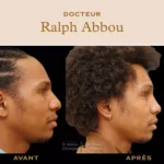 rhinoplastie ethnique paris