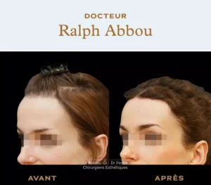 hairline lowering paris