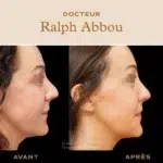 rhinoplastie ultrasonique paris