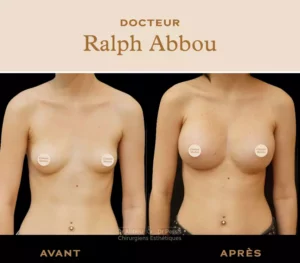 implants mammaires - photo avant apres augmentation mammaire