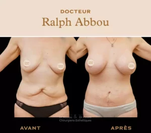 Augmentation mammaire par protheses paris après sleeve