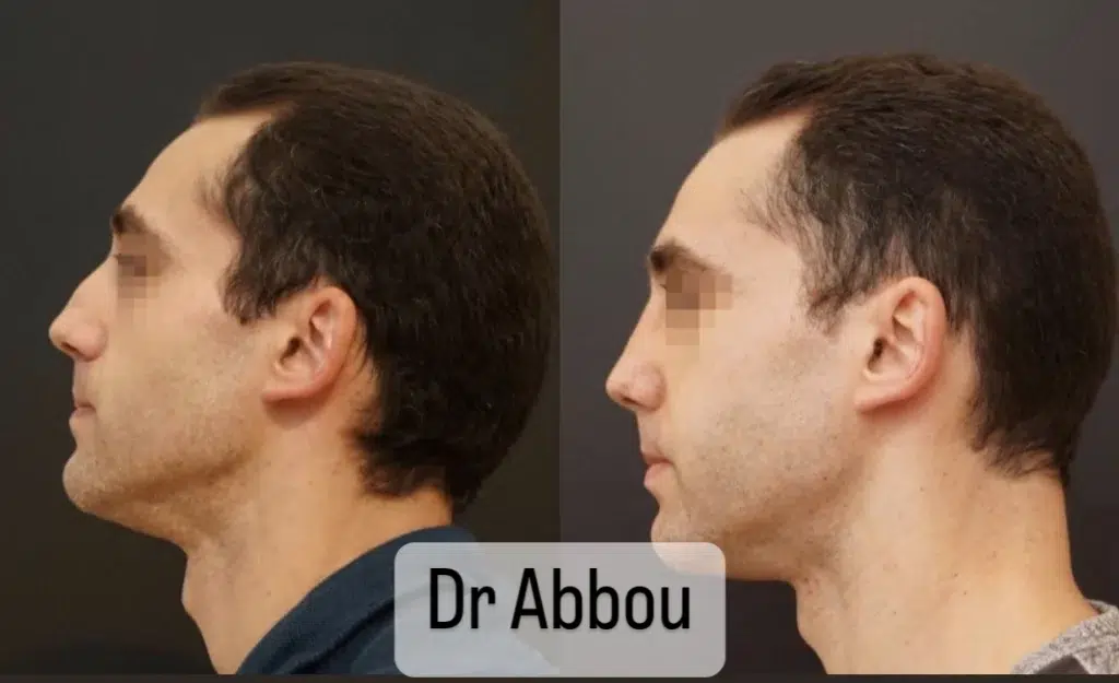 rhinoplastie ultrasonique