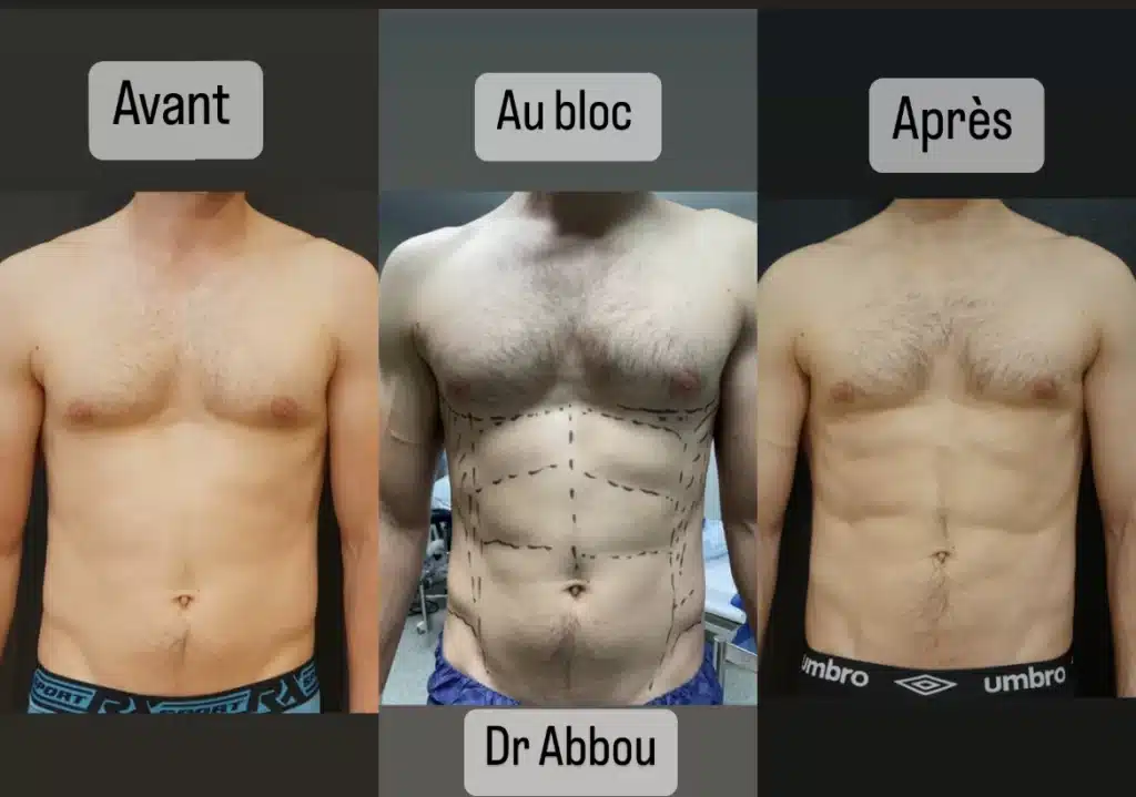 abdominal etching