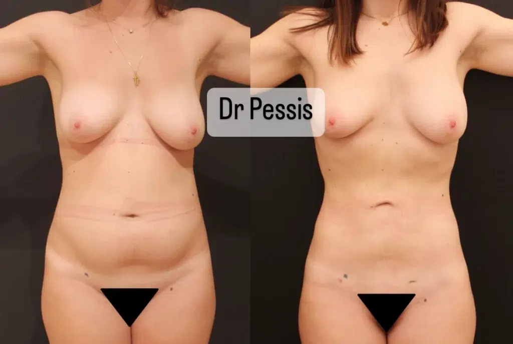 resultat lipoaspiration ventre femme