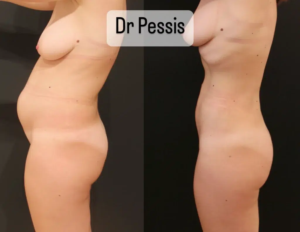 resultat liposuccion du ventre femme
