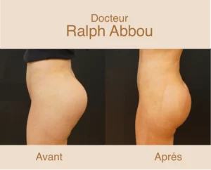 Changement protheses fesses à paris