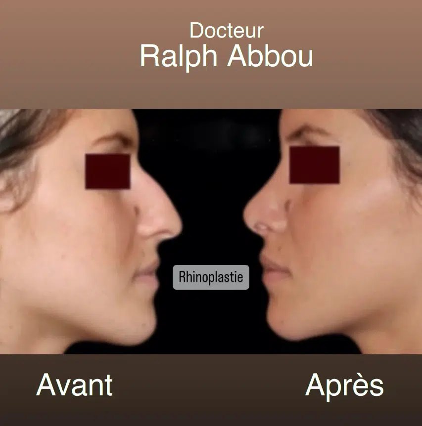 Rhinoplastie ultrasonique chirurgie paris