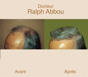 greffe-cheveux-paris