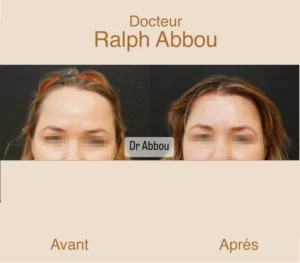 Réduction frontale ou abaissement front Dr Abbou chirurgien à paris