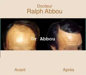 greffe-de-cheveux-paris
