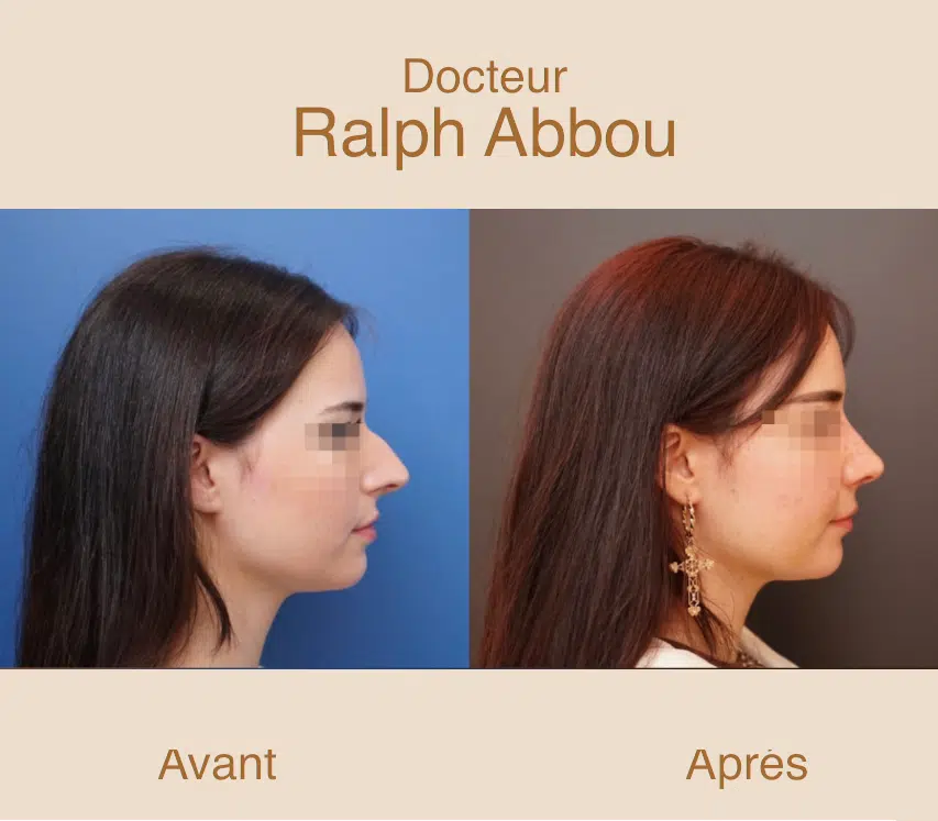 Rhinoplastie naturelle à Paris. Dr Ralph ABBOU