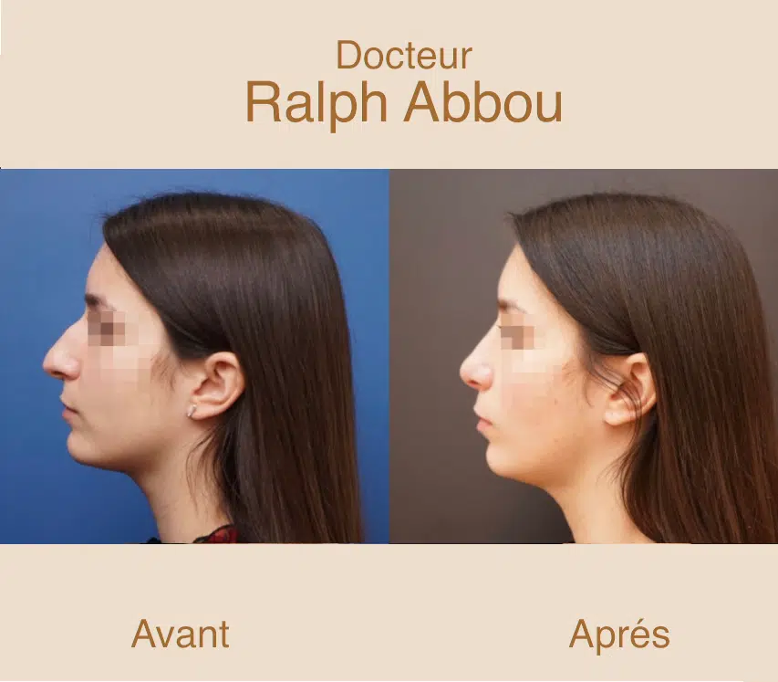 rhinoplastie ultrasonique paris