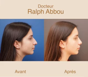 rhinoplastie ultrasonique paris