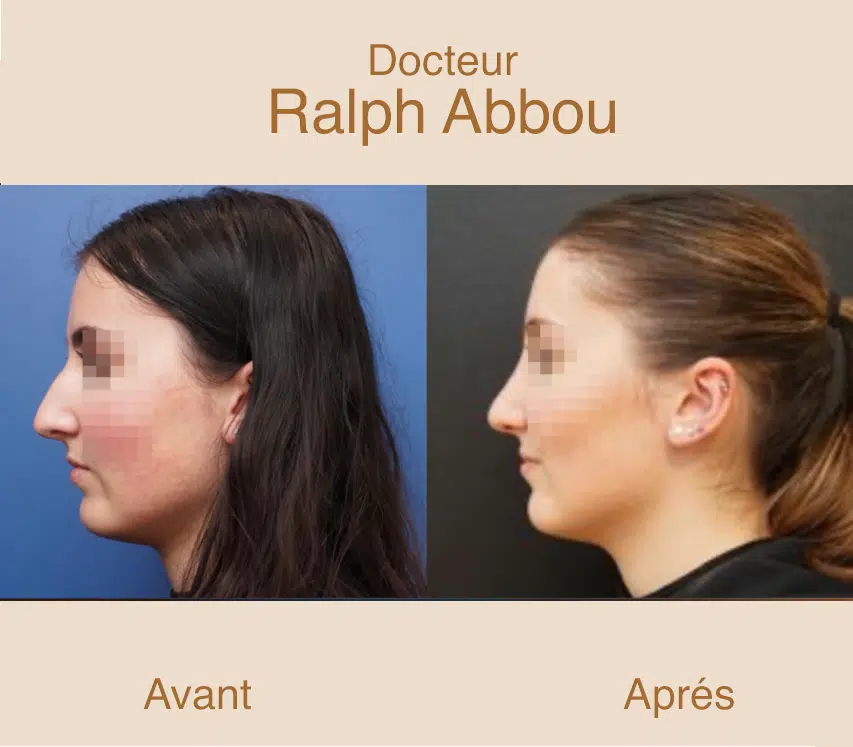 rhinoplastie ultrasonique paris