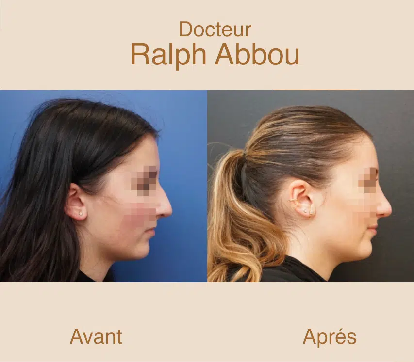rhinoplastie ultrasonique paris