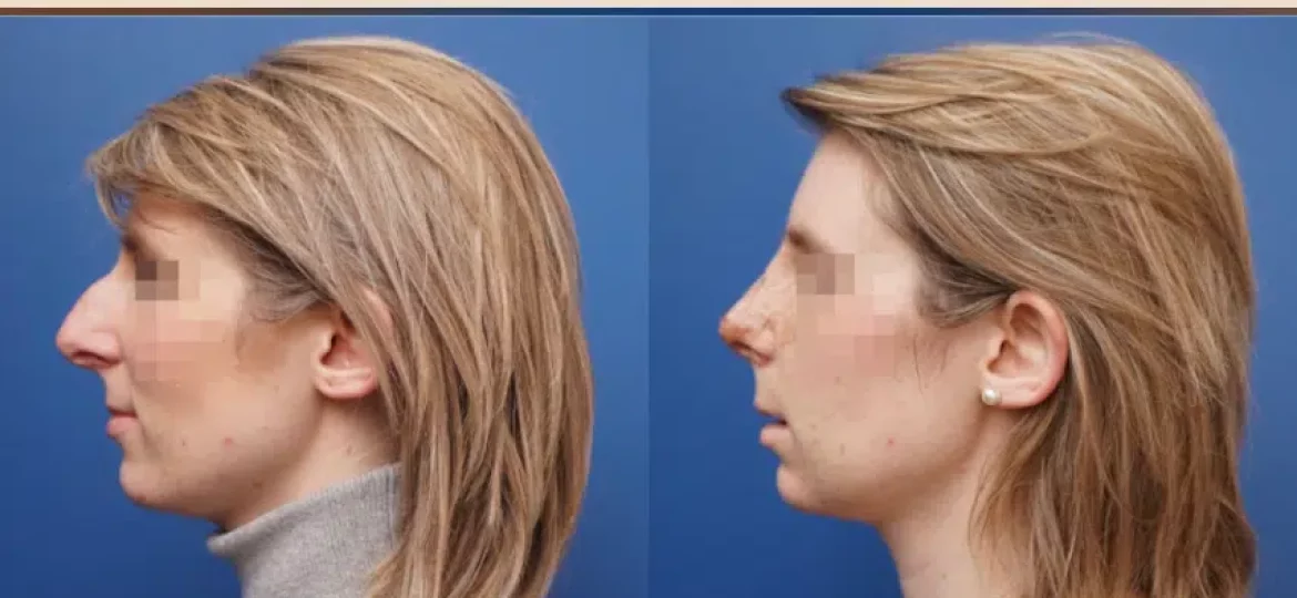 rhinoplastie ultrasonique paris