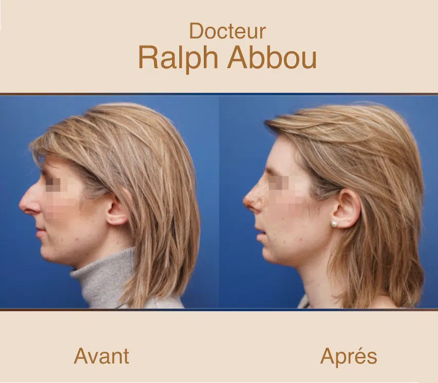 rhinoplastie ultrasonique paris