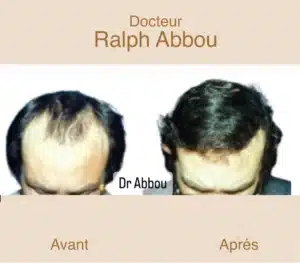 greffe-de-cheveux