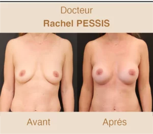 prothese mammaire - photo avant apres augmentation mammaire
