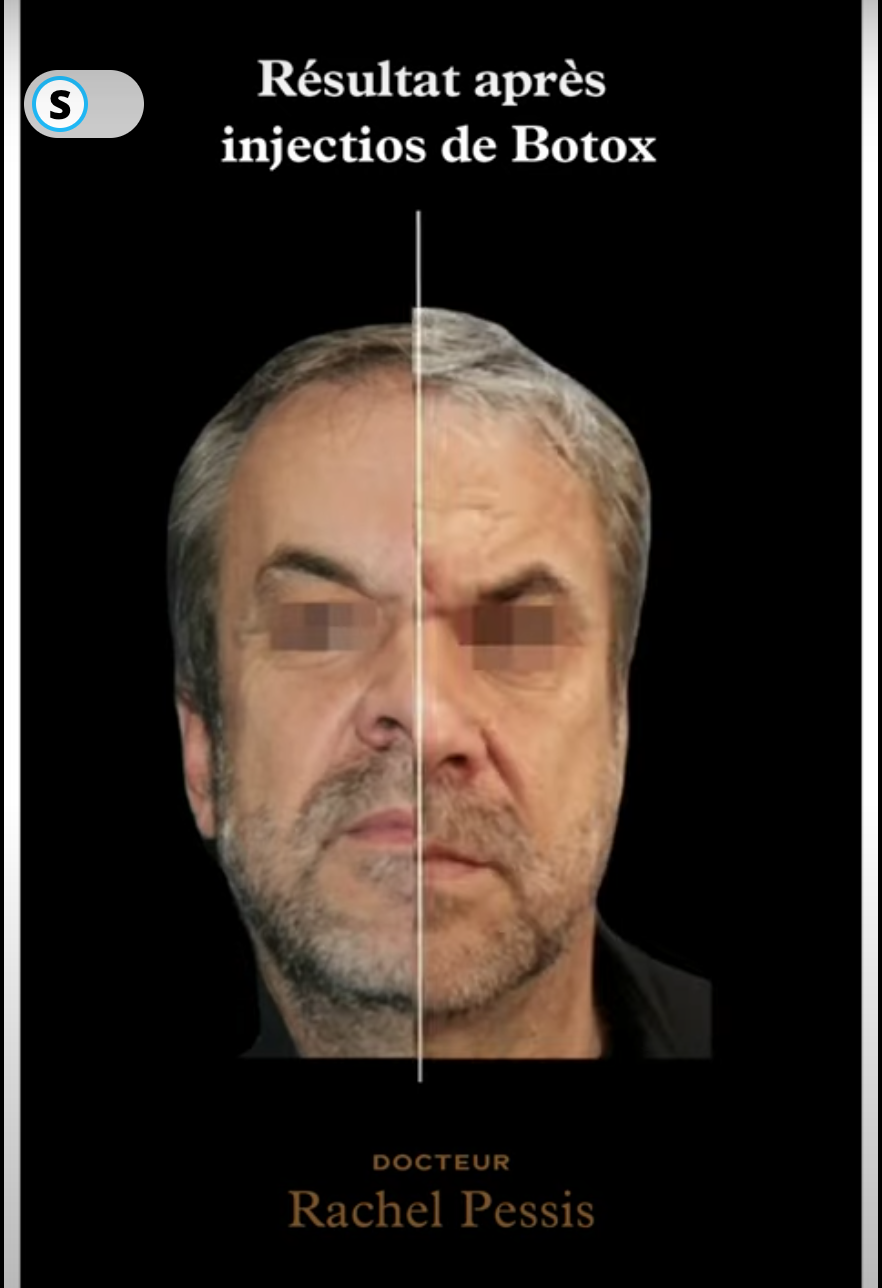 Botox avant apres - Dr Abbou et Dr Pessis, image size:882x1288
