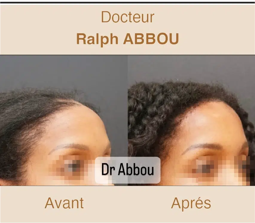 Traitement calvitie Paris. Dr Abbou et Dr Pessis